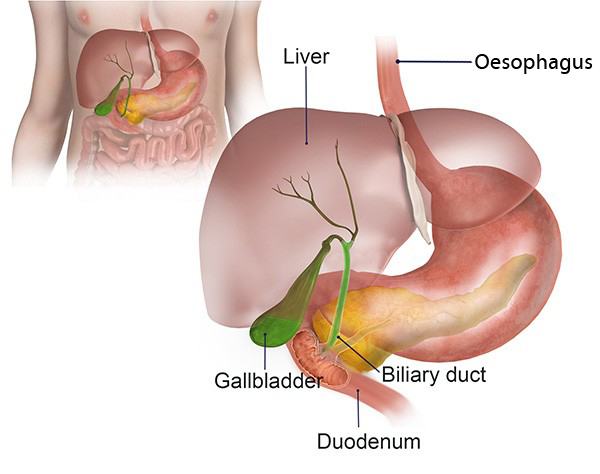 Bile Duct Obstructions Melbourne Gallstones Treatment Laparotomy 