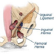 Private Femoral Hernia Repair Surgery