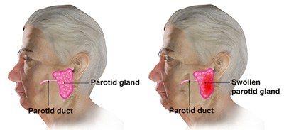 parotid gland swelling causes