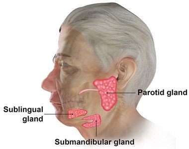 submandibular gland cyst